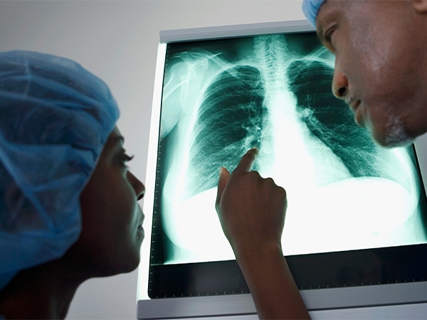 Lung nodules and lung cancer risk