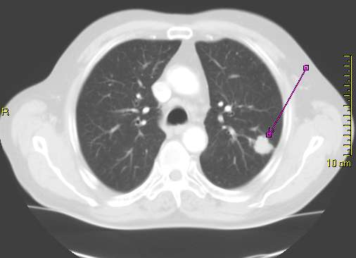 life expectancy for stage 4 colon cancer spread to liver without treatment