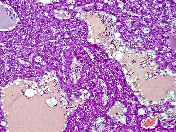 hepatocellular carcinoma - liver cancer cells in a rat