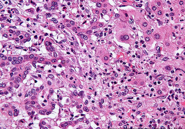 Targeting Bile Duct Cancer