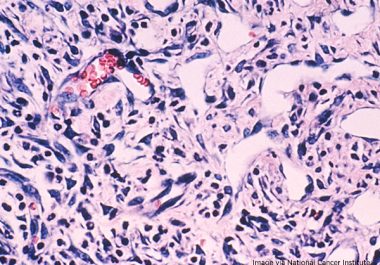 New Treatment for Kaposi Sarcoma