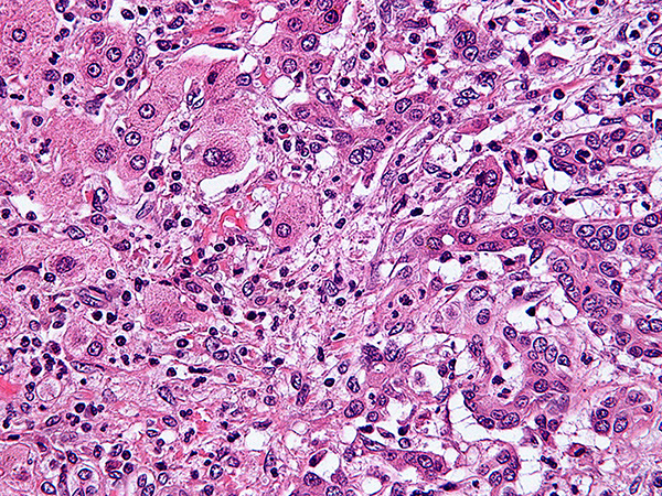 A micrograph of cholangiocarcinoma.