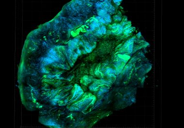 Identifying a Novel Combination Therapy for Epithelial Ovarian Cancer