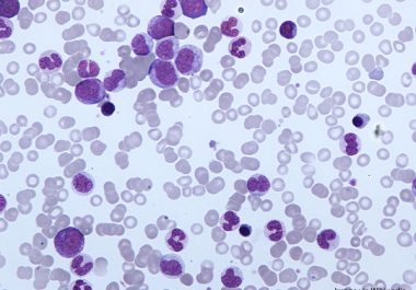 A New Combination Therapy for a Rare Form of Leukemia