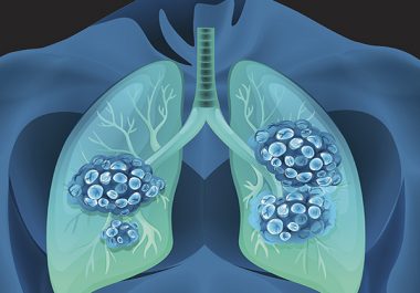 New Recommendation Nearly Doubles Lung Cancer Screening Eligibility