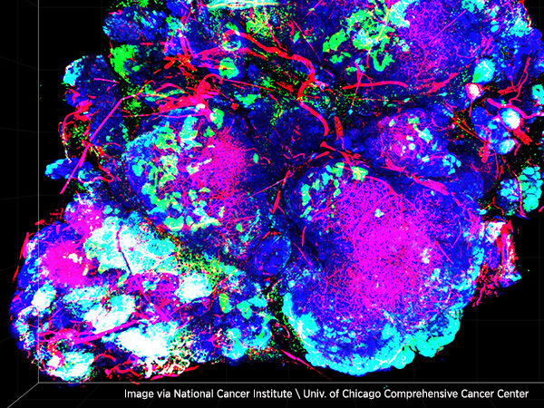 This image of a mouse model for HER2-positive breast cancer uses a novel imaging technique called transparent tumor tomography.