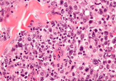 A Next-generation Treatment for Waldenström Macroglobulinemia  