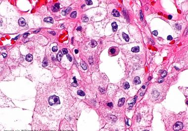 Combining Therapeutics to Treat Kidney Cancer