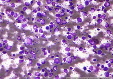 A New Immunotherapeutic for Patients With Lymphoma