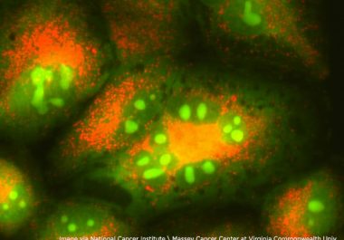A New Targeted Therapy and Diagnostic Test for Advanced Lung Cancer  
