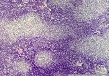Targeting Two Types of Lymphoma