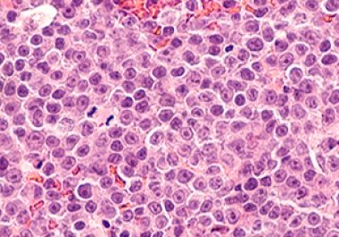 New Approval Adds to Growing List of Therapies for B-cell Lymphoma 