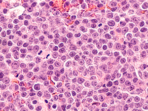 lymphoma slide