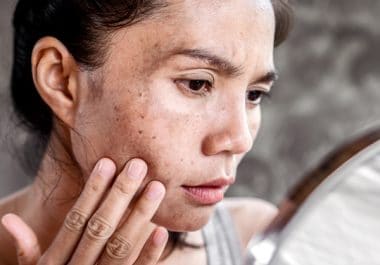 Signs of Skin Cancer