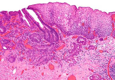 Combining Immunotherapy and Chemotherapy to Treat Esophageal Cancer 