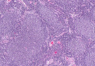 A Bispecific Antibody for Follicular Lymphoma 