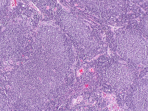 follicular lymphoma