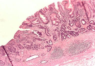 New Immunotherapy Combination Approved for Some Gastrointestinal Cancers  