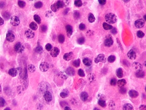 multiple myeloma