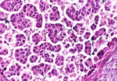 Targeting Urothelial Carcinoma 