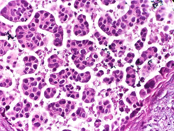 urothelial carcinoma