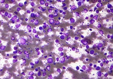 A New Targeted Therapy for a Common Blood Cancer 