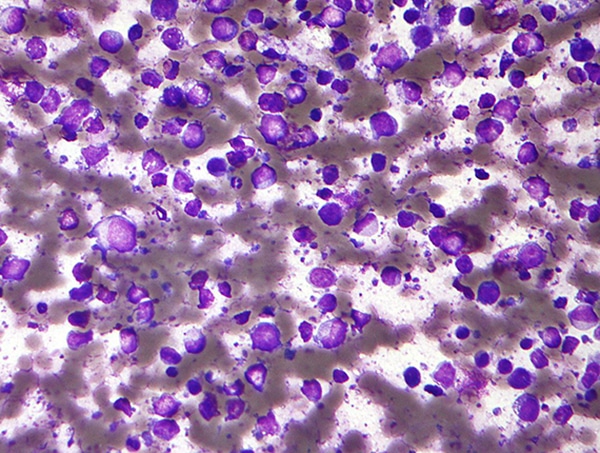 diffuse B-cell lymphoma