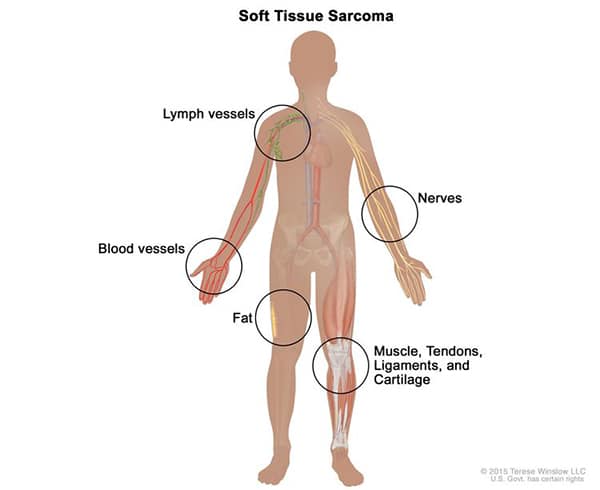 NCI sarcoma graphic