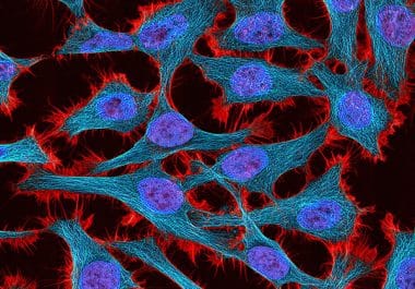 A New Immunotherapy Treatment Option for Advanced Cervical Cancer  