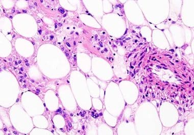 New Therapy for Rare Sarcoma  