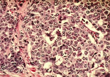 PARP Inhibitor Approved as Adjuvant Treatment for High-risk, Early Breast Cancer 