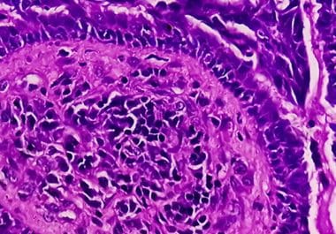 Immunotherapy Approved for Endometrial Cancer  