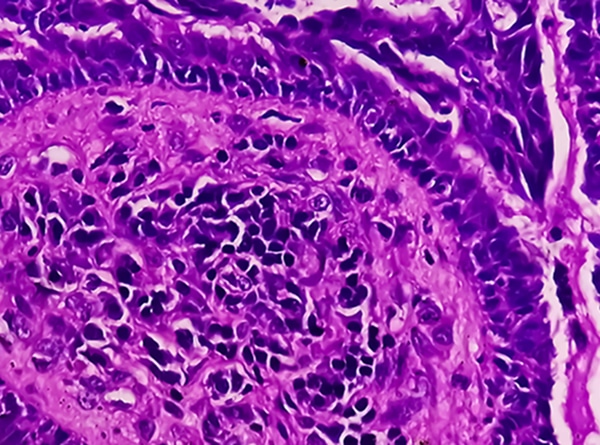endometrial cancer