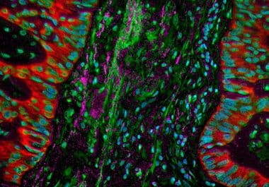 A New Immunotherapy Option and Diagnostic Test for Early Lung Cancer  