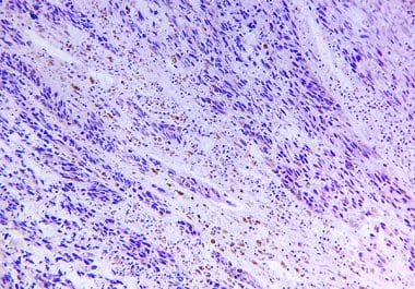 Immunotherapy for Earlier Stages of Melanoma 