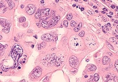 Lighting Up Tumors to Improve Ovarian Cancer Surgery 