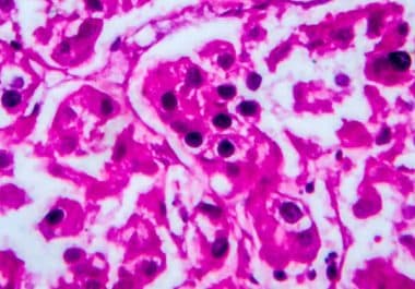 An Immunotherapy Option for Treating Kidney Cancer 