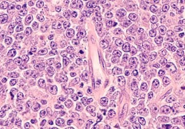 Earlier-line Immunotherapy Treatment for Lymphoma 