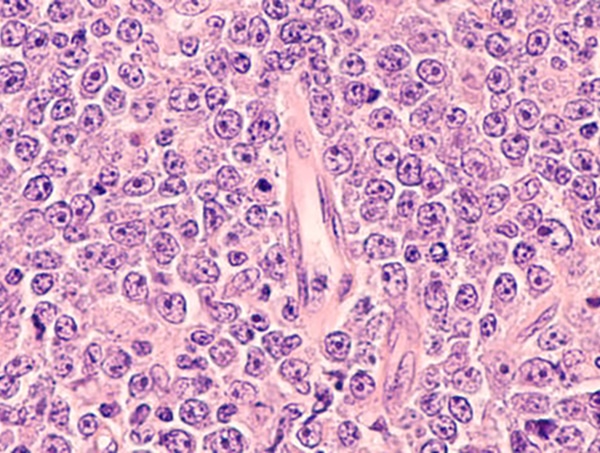 DLCBL lymphoma