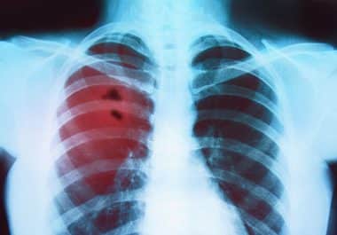 New Immunotherapy for Metastatic Lung Cancer 