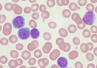 A New Targeted Therapy for Certain Blood Cancers