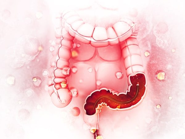 Seeking Clues to Early-onset Colorectal Cancer 