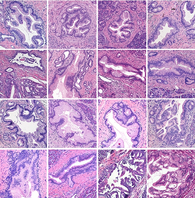 pancreatic cancer images