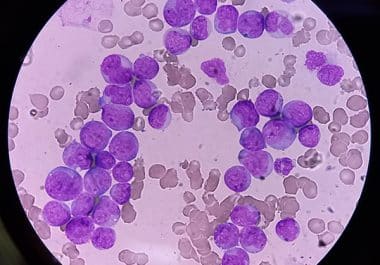 New Targeted Therapy Bolsters Standard Treatment for Acute Myeloid Leukemia 