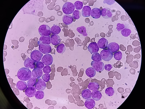 AML image