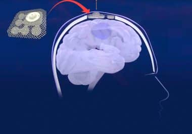 Ultrasound Device Opens Blood-brain Barrier