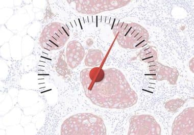 Moving the Needle on Metastatic Breast Cancer