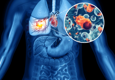 Another Combination Targeted Therapy for Metastatic Lung Cancer  