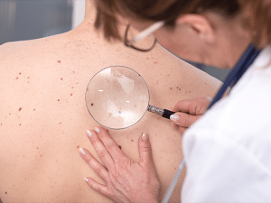 A dermatologist examining a patient's skin with a microscope to look for signs of melanoma.