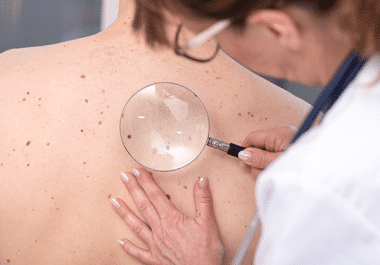 Immune Checkpoint Therapy Approved for Non-metastatic Melanoma After Surgery